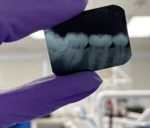 Radiografia de dentes periapical que ilustra um dente do siso mau posicionado
