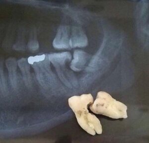 Fotografia mostrando uma parte de uma radiografia panorâmica dental e, posicionados sobre ela, os dentes que foram removidos durante a cirurgia. Na radiografia é possível identificar um terceiro molar (dente do siso) que estava crescendo em posição inadequada, pressionando e danificando a raiz do segundo molar vizinho. Os dentes extraídos físicos confirmam o diagnóstico visto na imagem de raio-X.