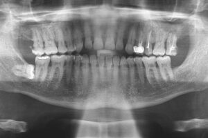 Radiografia panorâmica dental completa mostrando todos os dentes da boca. Na região inferior esquerda da imagem, é possível identificar um terceiro molar (dente do siso) em posição horizontal, deitado, diferente da posição vertical normal dos outros dentes. Esta posição anormal do siso pode causar problemas como dor, inchaço ou danos aos dentes vizinhos.
