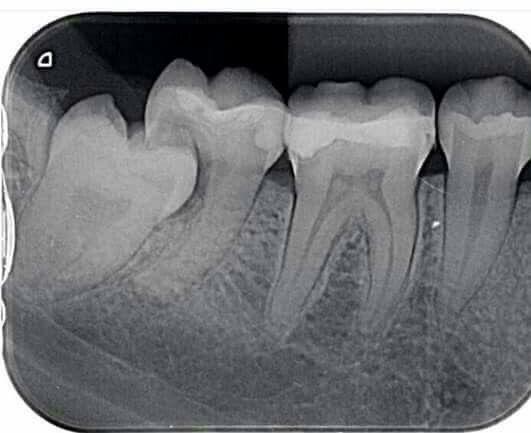 "Imagem de raio-X dental mostrando três dentes do fundo da boca: o dente do siso, o segundo e o primeiro molar. O dente do siso está crescendo em posição incorreta, na horizontal, e está pressionando o dente vizinho (segundo molar). Esta pressão causou um desgaste na raiz do segundo molar, onde é possível ver que parte da estrutura já foi danificada pelo contato com o siso mal posicionado.