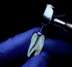 Tratamento de canal: dente cortado ao meio com lima endodôntica limpando um canal, outro canal selado. Mão com luva azul segura o dente.